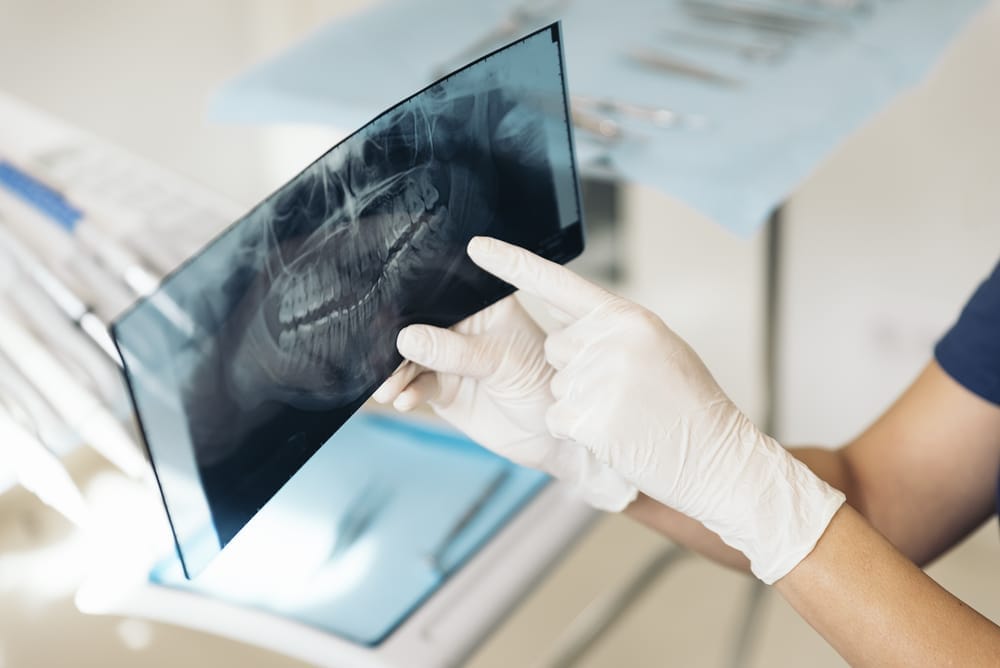 Reviewing a Panoramic Dental X Ray Dental professional in gloves pointing to a panoramic X ray film of the teeth and jaw