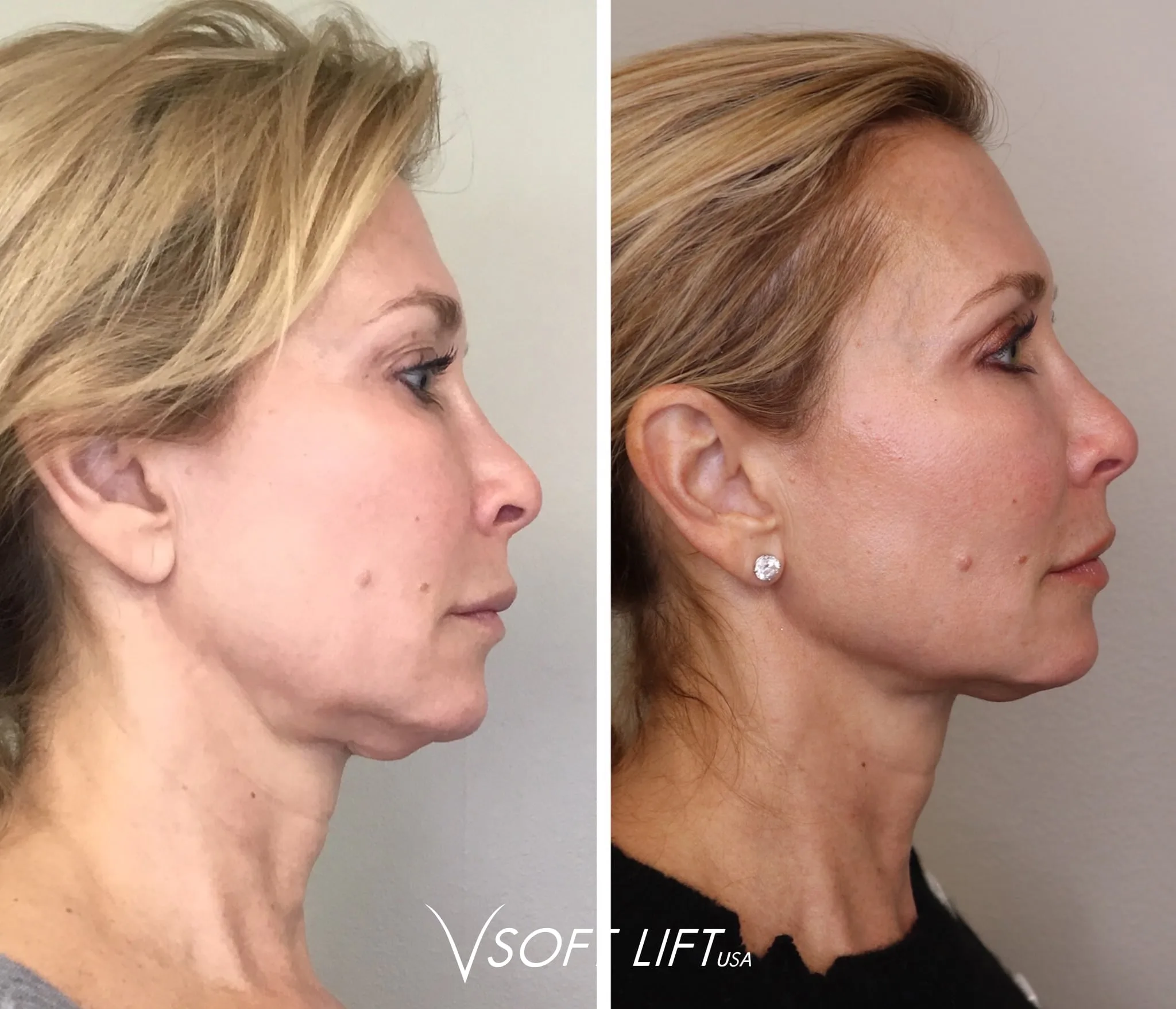 Side-by-side profile photos of a woman showing before and after results of a facial thread lift.