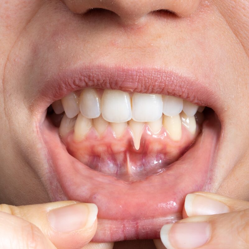 Macro,Of,A,Female,Mouth,With,Receding,Gums.,Close-up,Of